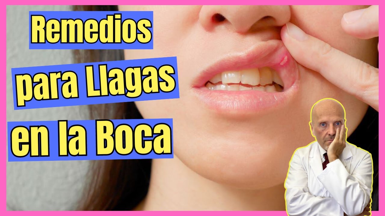 aftas en la lengua remedios caseros