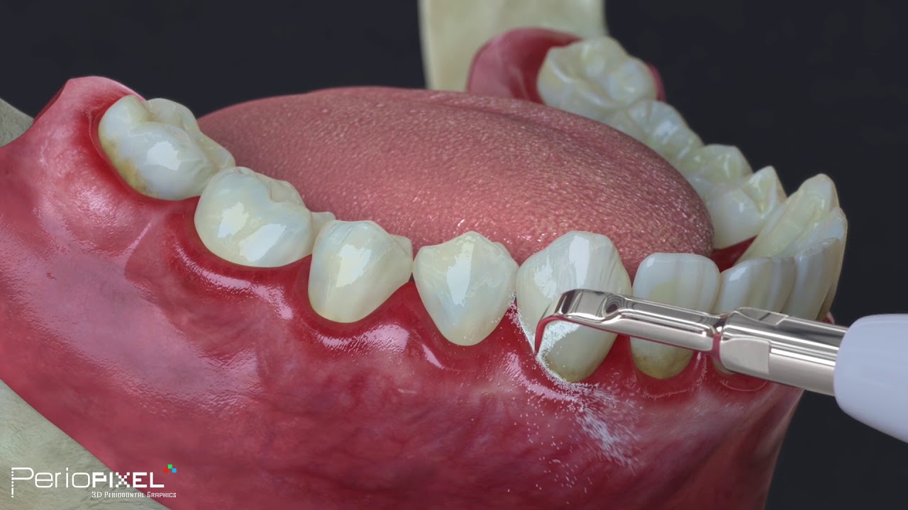 curetaje dental periodontitis avanzada antes y despues