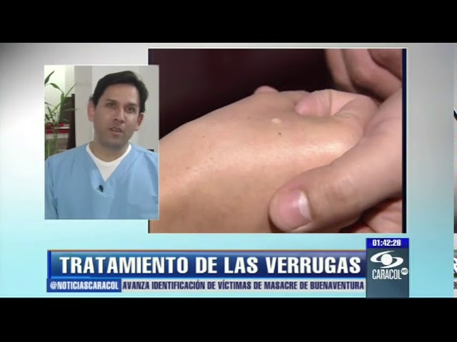 papiloma en el dedo de la mano