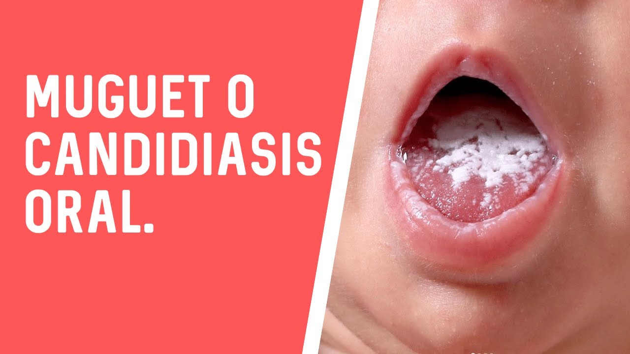 porque tienen la lengua blanca los bebes