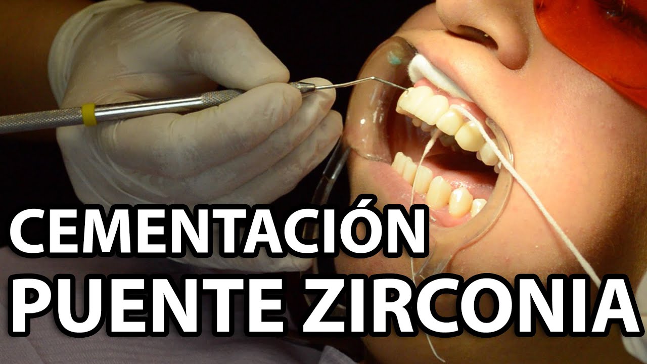 puente de zirconio 4 piezas precio