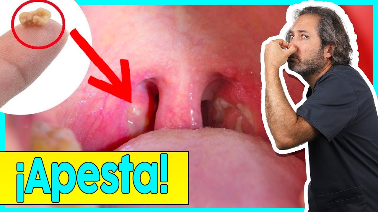 puntitos blancos en la garganta sin dolor