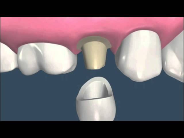 como se pone una funda dental